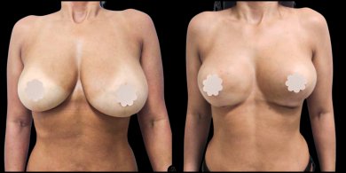 before-after photo mommy-makeover