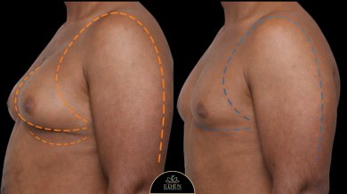 before-after photo gynecomastia-surgery