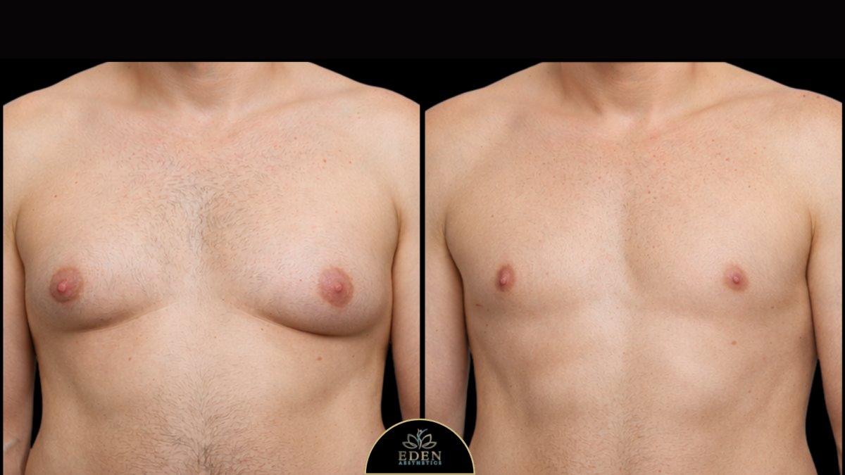 Resultados antes y después de cirugía de ginecomastia en EDEN AESTHETICS, contorno masculino