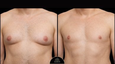 before-after photo gynecomastia-surgery