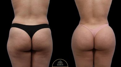 before-after photo brazilian-butt-lift