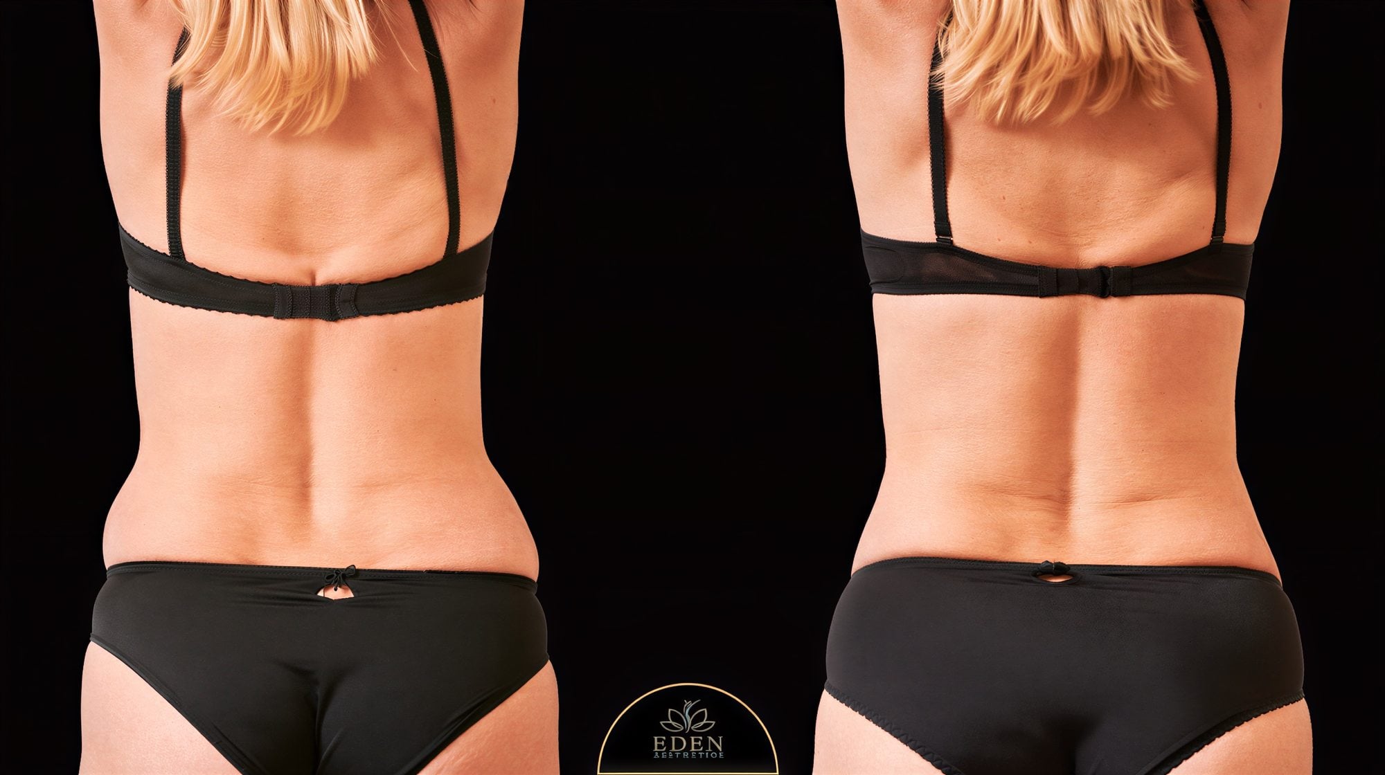 نتائج شفط الدهون قبل وبعد في EDEN AESTHETICS – تحسين محيط الخصر