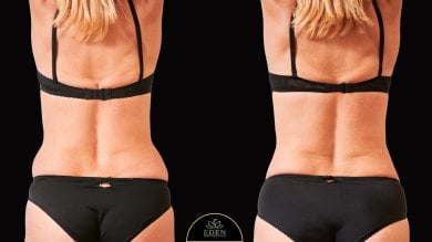 before-after photo liposuction