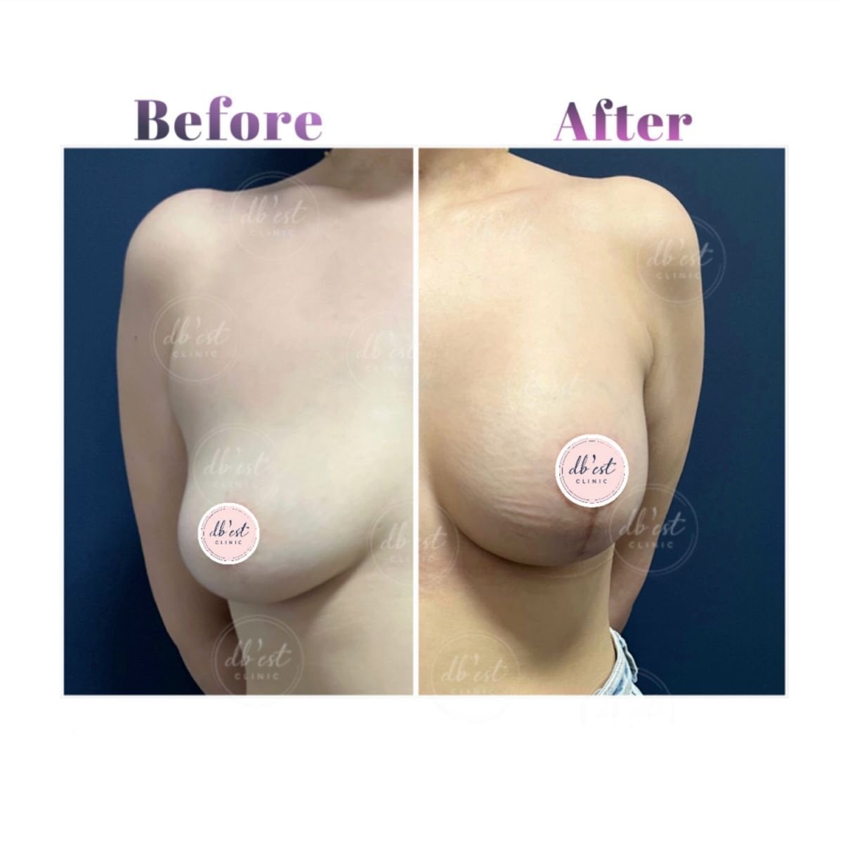 نتائج تكبير الثدي قبل وبعد في عيادة Db'est، زيادة حجم الثدي