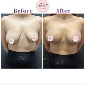 before-after photo breast-augmentation