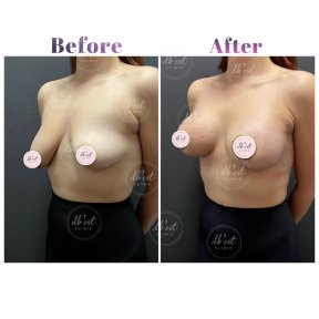 before-after photo breast-augmentation