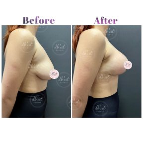 before-after photo breast-augmentation