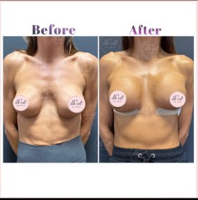 before-after photo breast-augmentation
