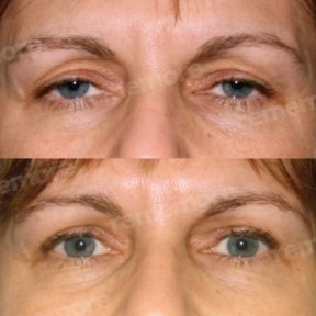 before-after photo upper-and-lower-eyelid-surgery