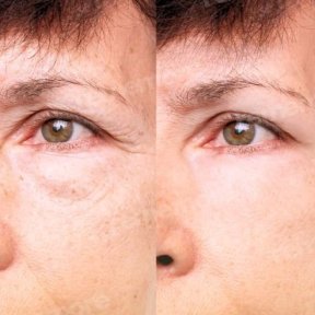 before-after photo upper-and-lower-eyelid-surgery