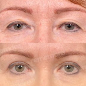 before-after photo upper-and-lower-eyelid-surgery