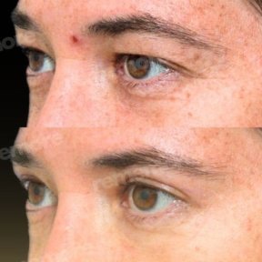 before-after photo upper-and-lower-eyelid-surgery