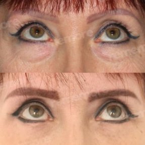 before-after photo upper-and-lower-eyelid-surgery