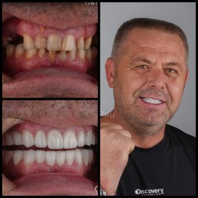 before-after photo dental-implant