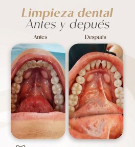 before-after photo teeth-cleaning