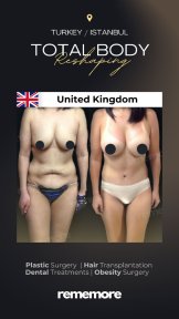 before-after photo thigh-lift
