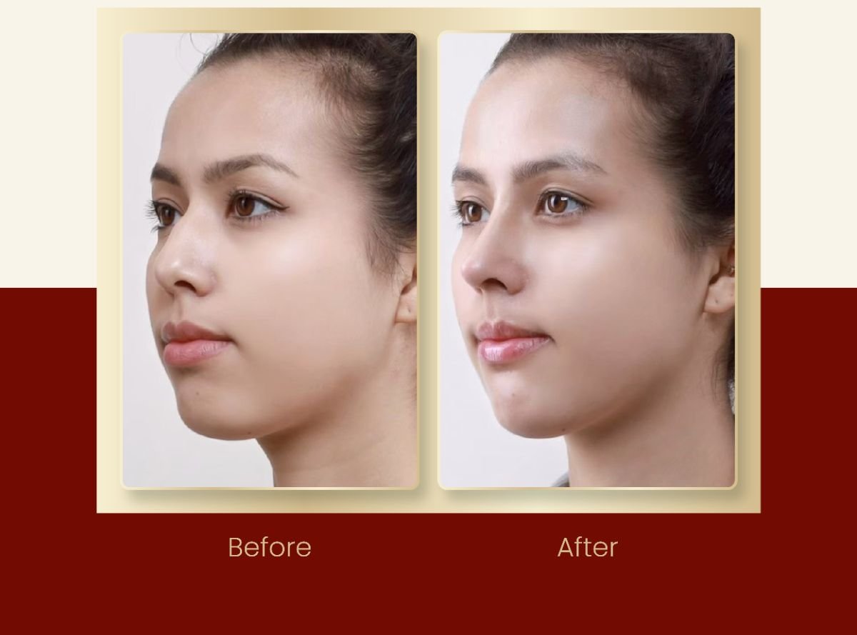 Resultados de septoplastia antes y después en DGB Clinic, mejor simetría y respiración nasal