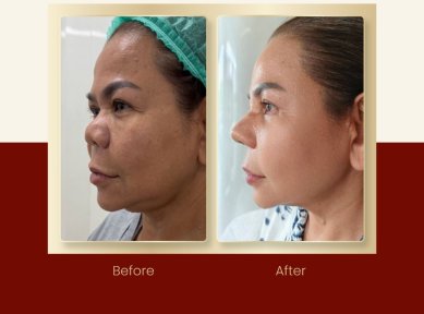 Résultats avant/après septoplastie à la DGB Clinic, profil nasal et respiration améliorés