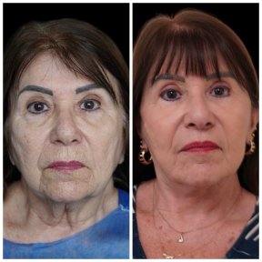 before-after photo blepharoplasty-eyelid