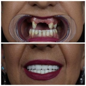 before-after photo all-on-6-dental-implants