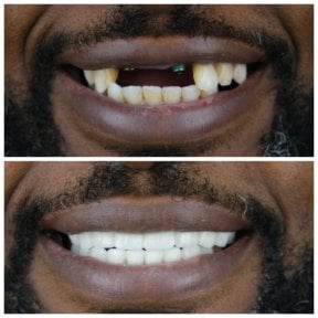 before-after photo all-on-4-dental-implants