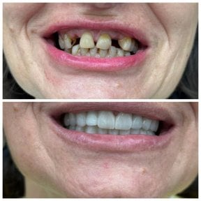before-after photo all-on-4-dental-implants