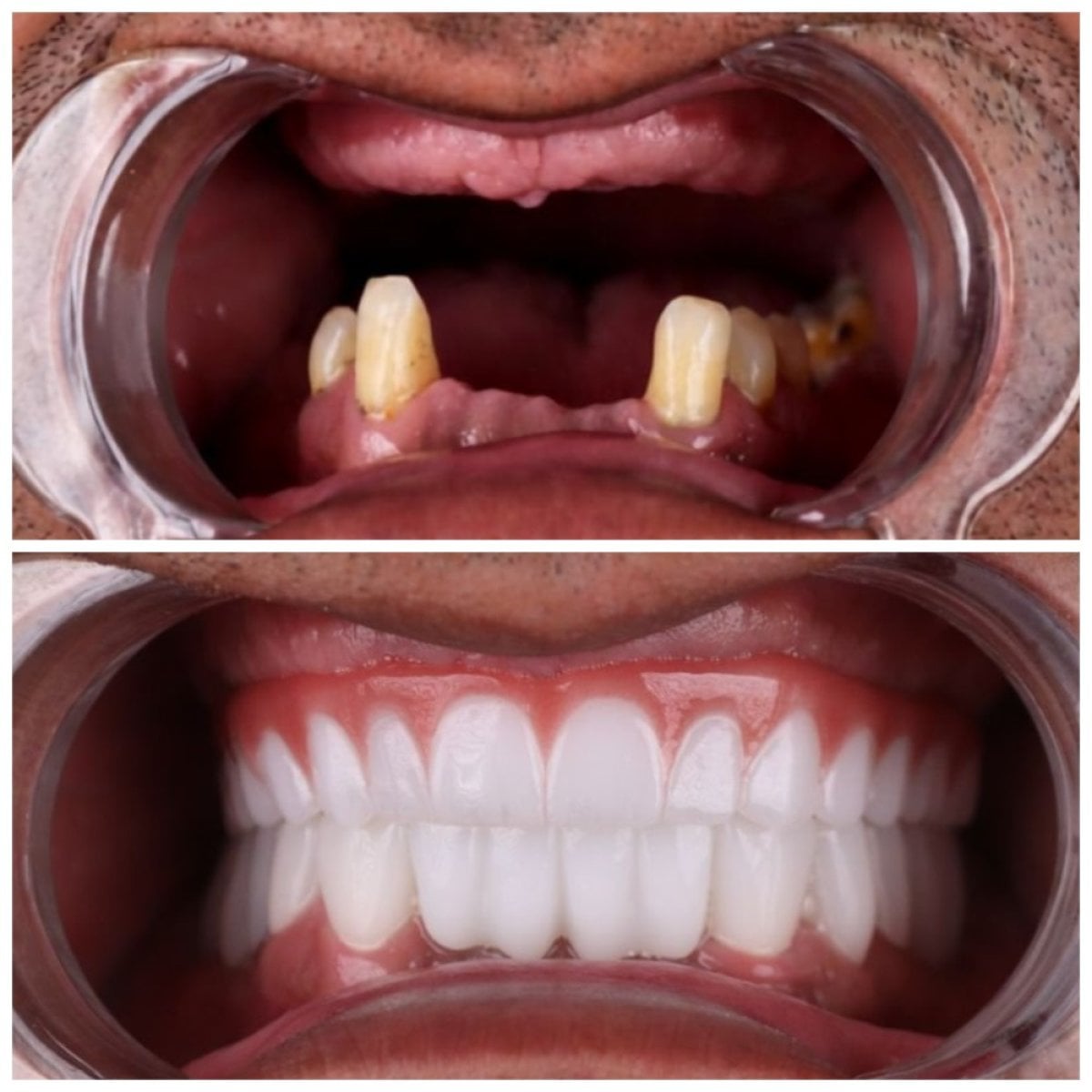 Resultados antes y después de implantes dentales All-on-4 en TH Dental Clinic, sonrisa restaurada
