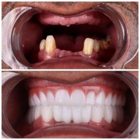 before-after photo all-on-4-dental-implants