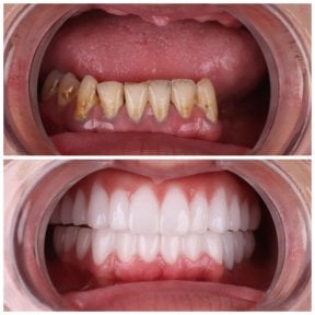 before-after photo all-on-4-dental-implants