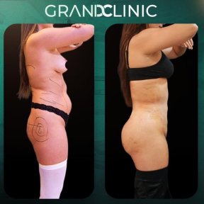 before-after photo brazilian-butt-lift
