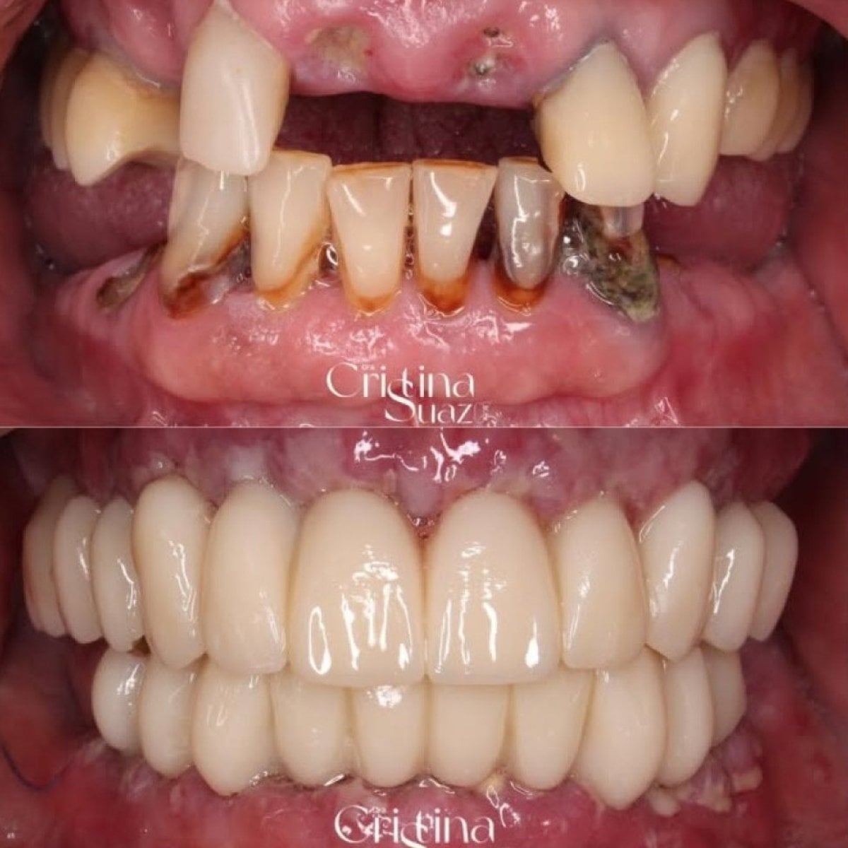 قبل وبعد تجميل الابتسامة في Dentica by Cristina Suaza، نتائج ترميم الأسنان الكاملة