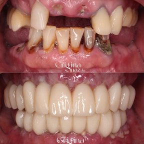 before-after photo smile-makeover