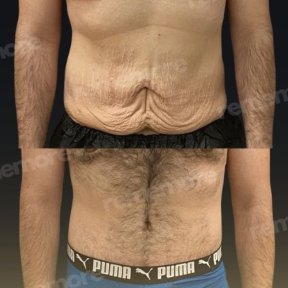 before-after photo abdominoplasty