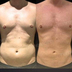before-after photo abdominoplasty