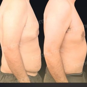before-after photo abdominoplasty