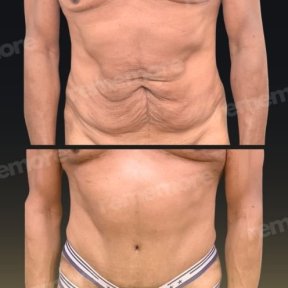 before-after photo abdominoplasty