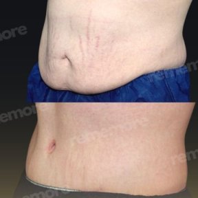 before-after photo abdominoplasty