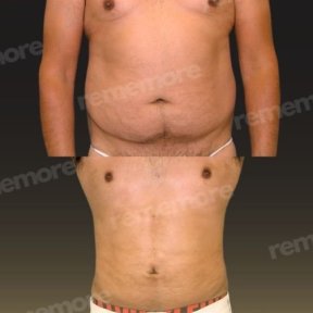 before-after photo abdominoplasty
