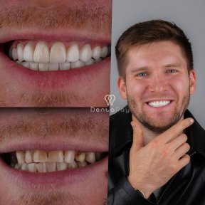 before-after photo hollywood-smile
