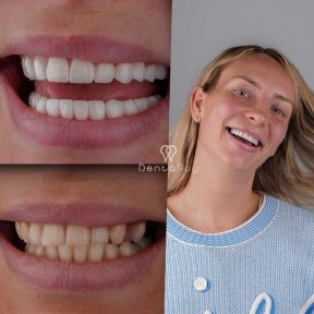 before-after photo hollywood-smile
