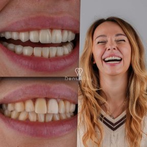 before-after photo hollywood-smile