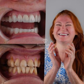 before-after photo hollywood-smile