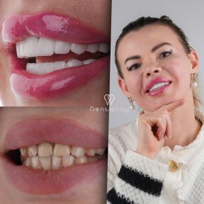before-after photo hollywood-smile