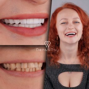 before-after photo hollywood-smile