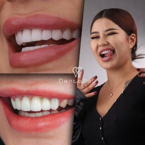 before-after photo hollywood-smile