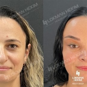 before-after photo facial-fat-transfer