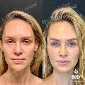 before-after photo facial-fat-transfer