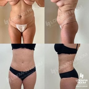 before-after photo facial-fat-transfer