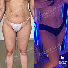 before-after photo facial-fat-transfer