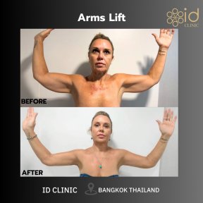Результаты до и после подтяжки рук в ID Clinic Bangkok, улучшенный контур и упругость